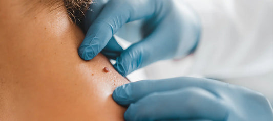 Skin Tag Removal